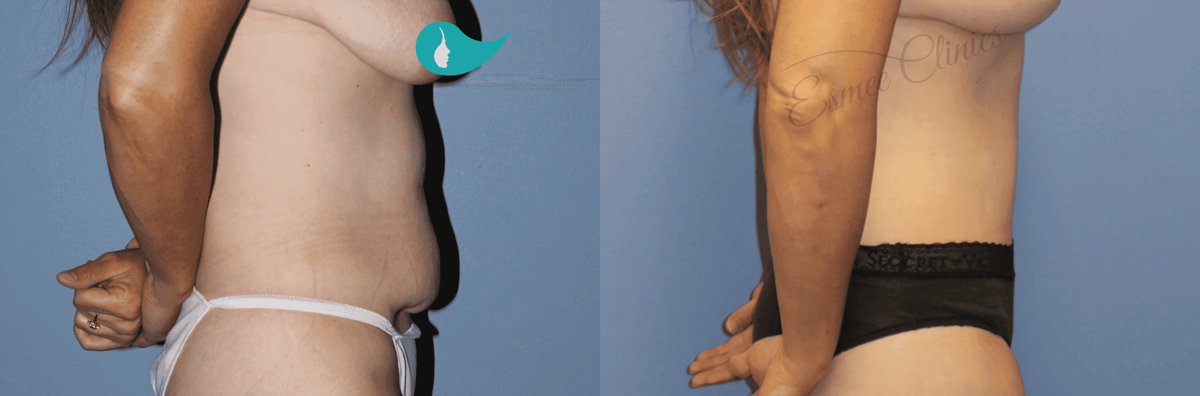 Before and After img